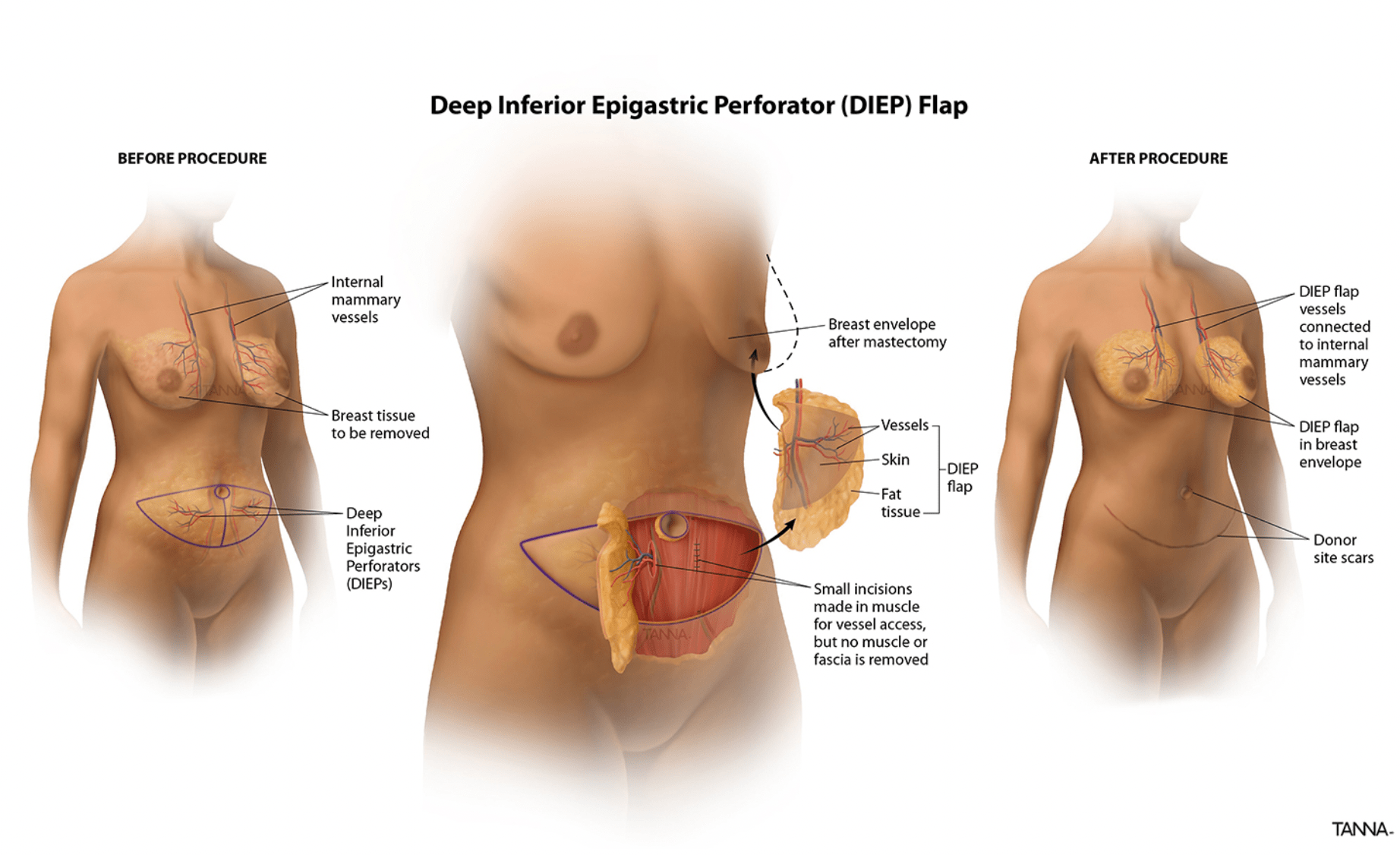 Infographic of a DIEP Flap