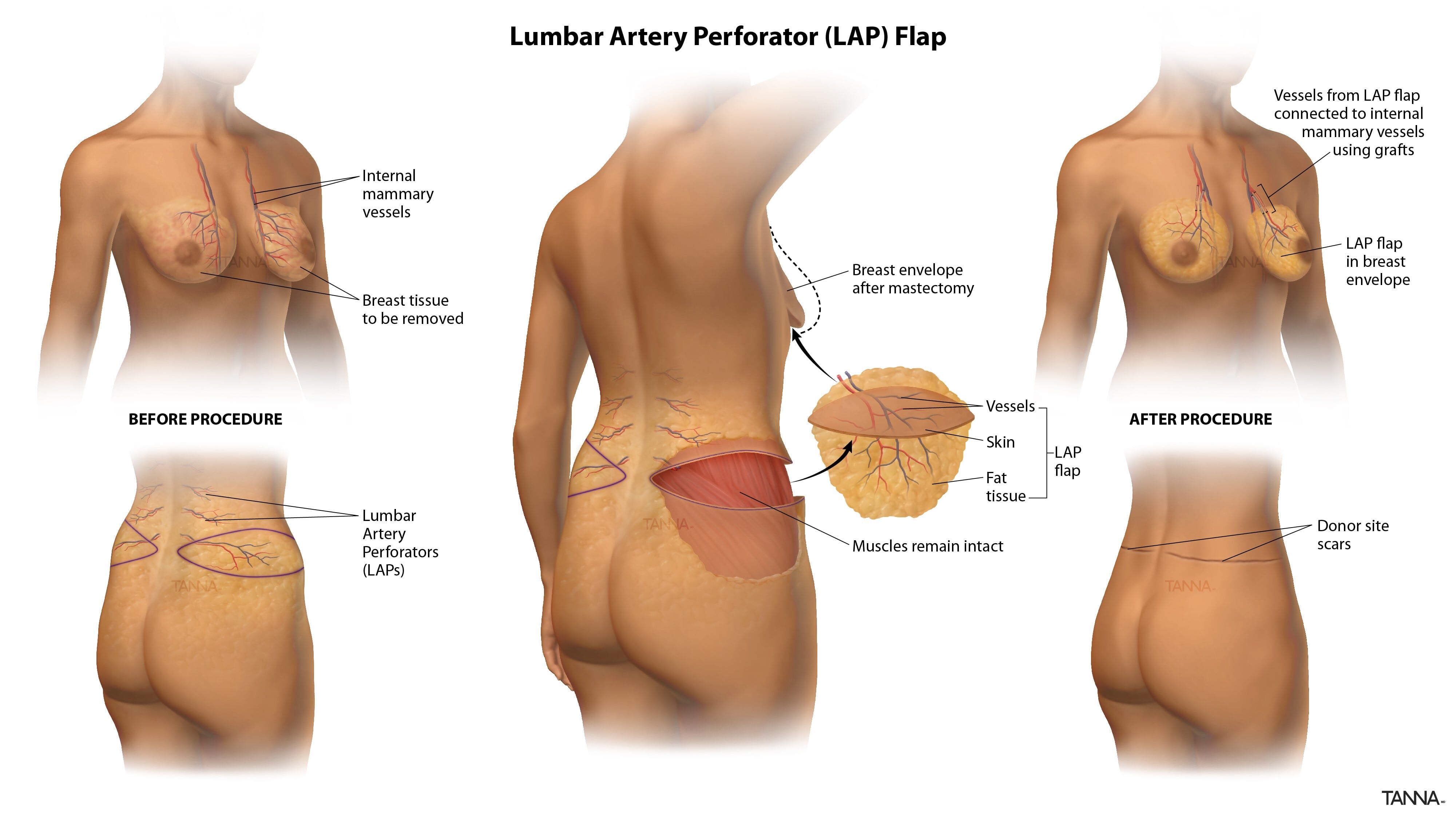 LAP Inforgraphic