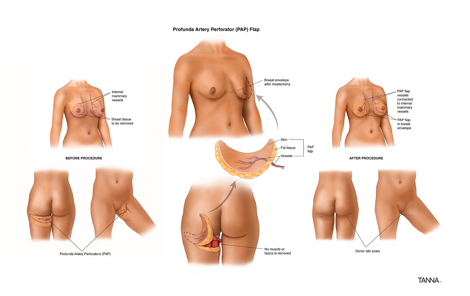 (PAP) Flap Infographic