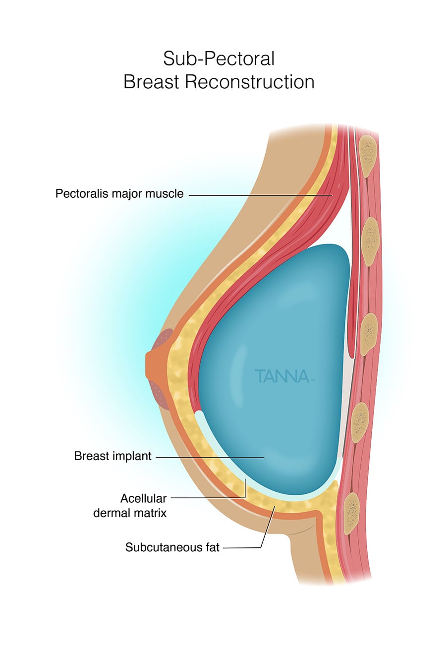 Sub Pectoral Infographic