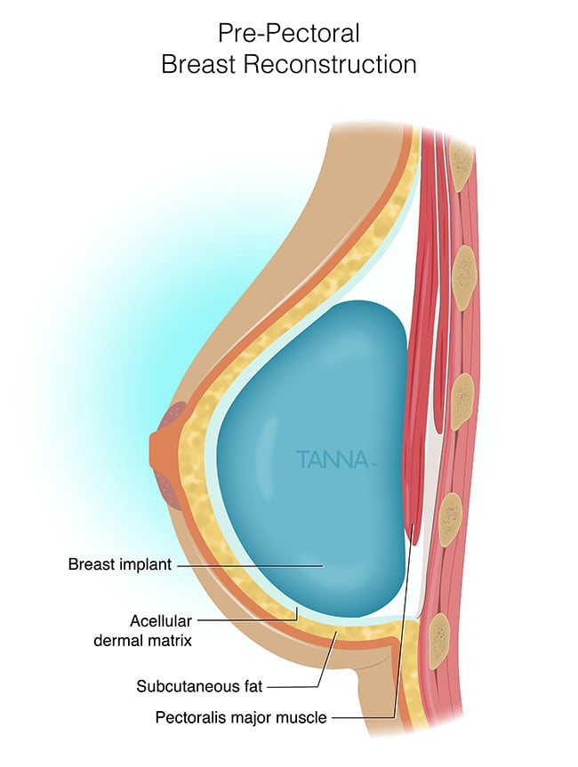 Pre-pectoral Infographic