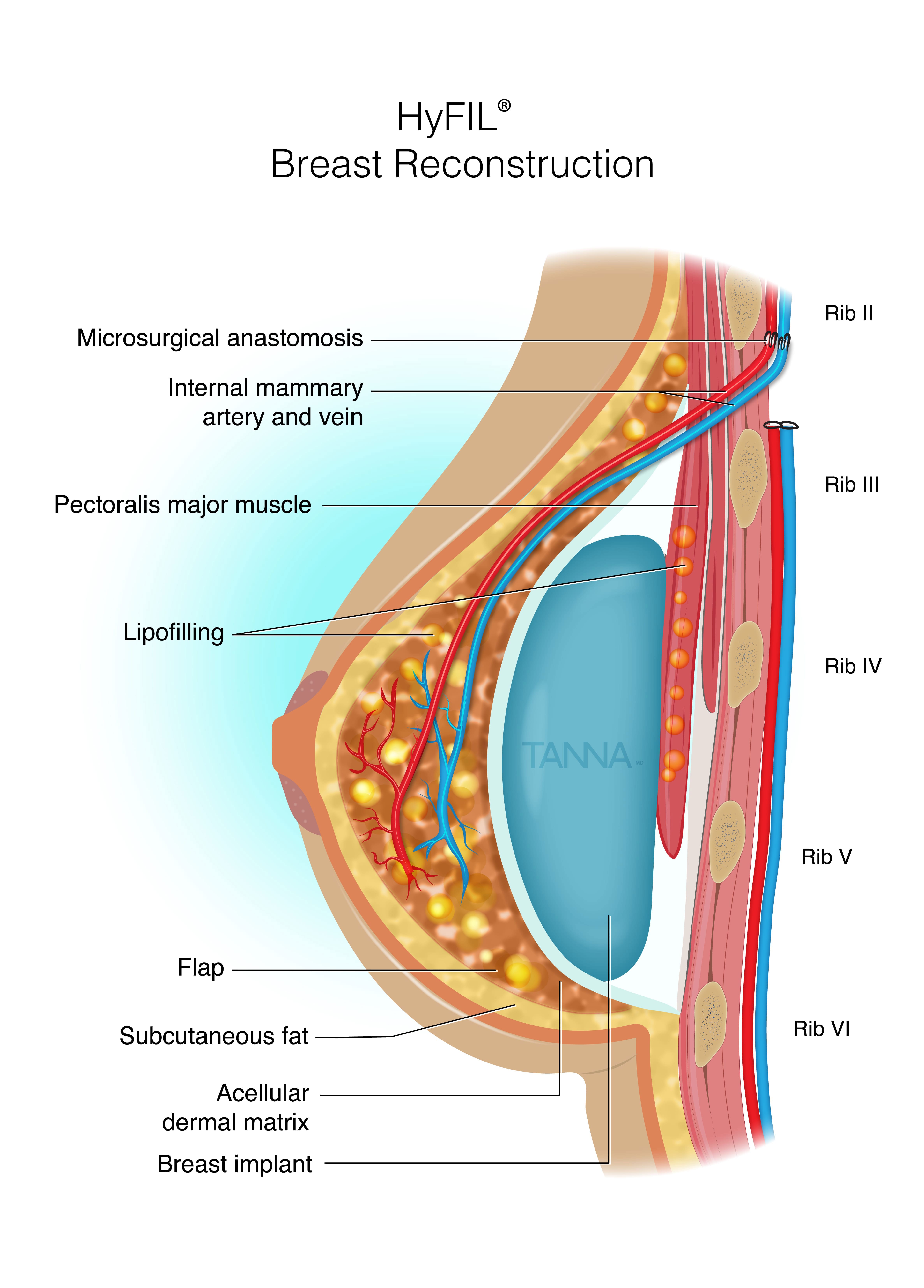 Hyfil Breast Reconstruction Inforgraphic