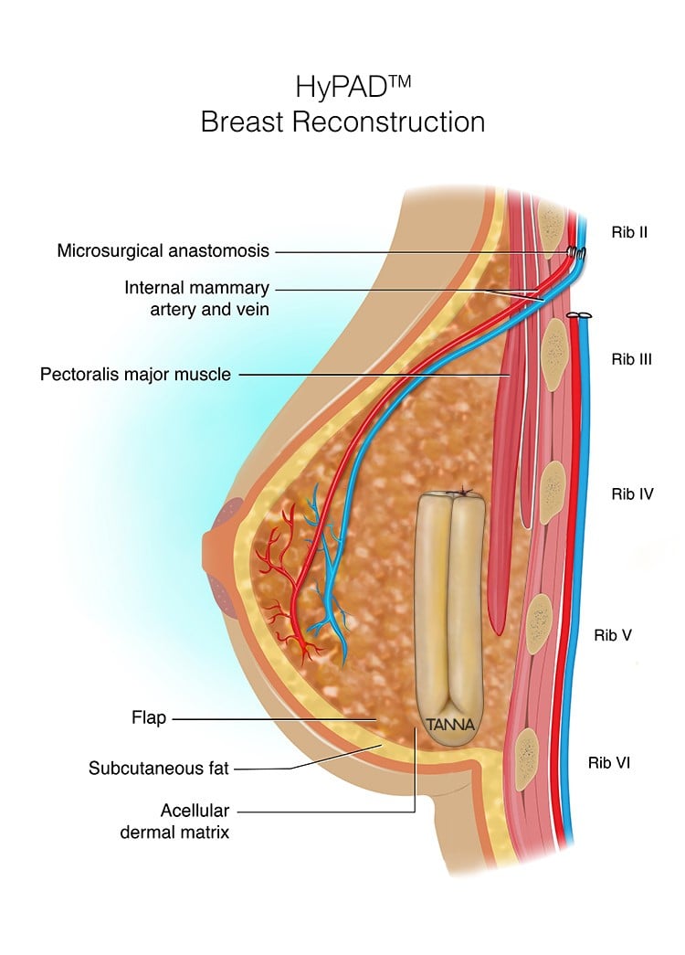 HyPAD Breast Reconstruction Infographic