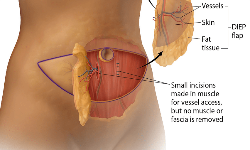 Robotic Mastectomy Infographic