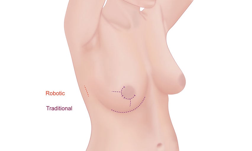 Robotic Mastectomy Infographic
