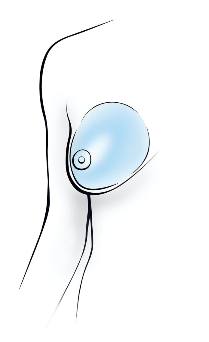 Graphic of a Breast