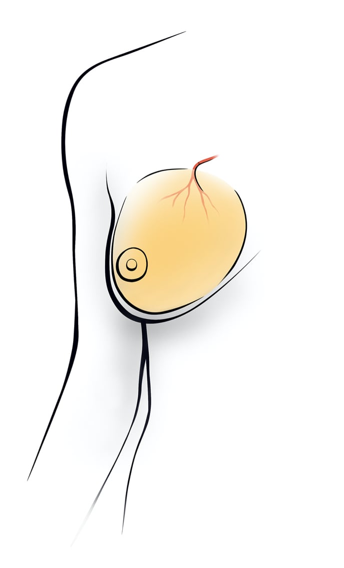 Graphic of a Breast