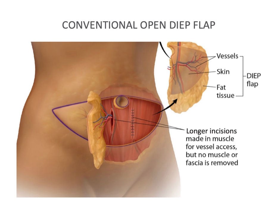 Graphic of Conventional Open Diep Flap