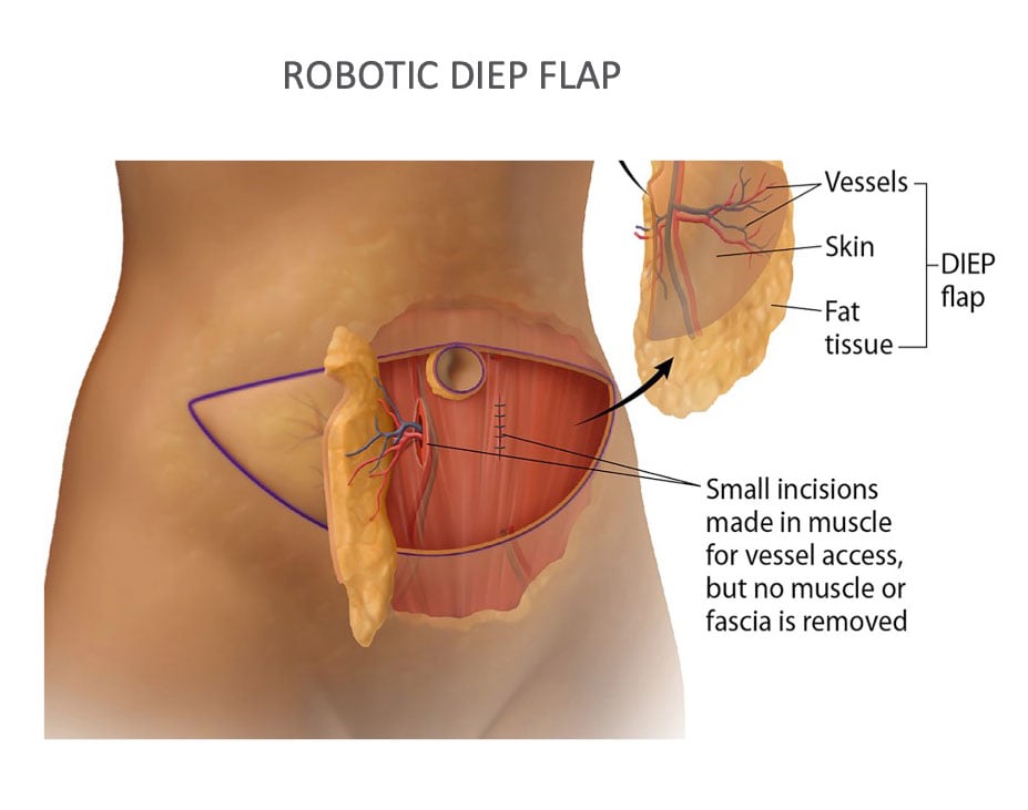 Graphic of Robotic Open Diep Flap