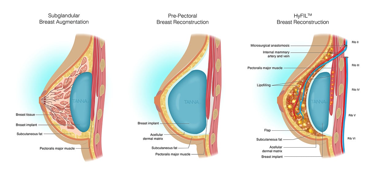 Breast Augmentation Infographic