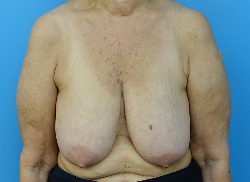 Breast Reduction Before & After Gallery - Patient 121727772 - Image 5