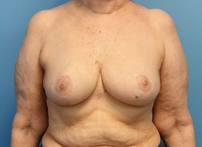 Breast Reduction Before & After Gallery - Patient 121727772 - Image 6