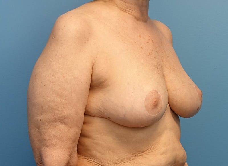 Breast Reduction Before & After Gallery - Patient 121727772 - Image 8