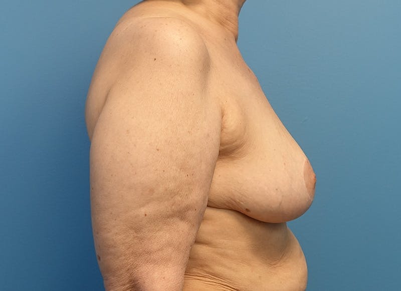 Breast Reduction Before & After Gallery - Patient 121727772 - Image 10