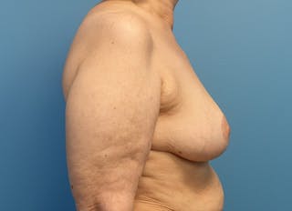 Breast Reduction Before & After Gallery - Patient 121727772 - Image 10