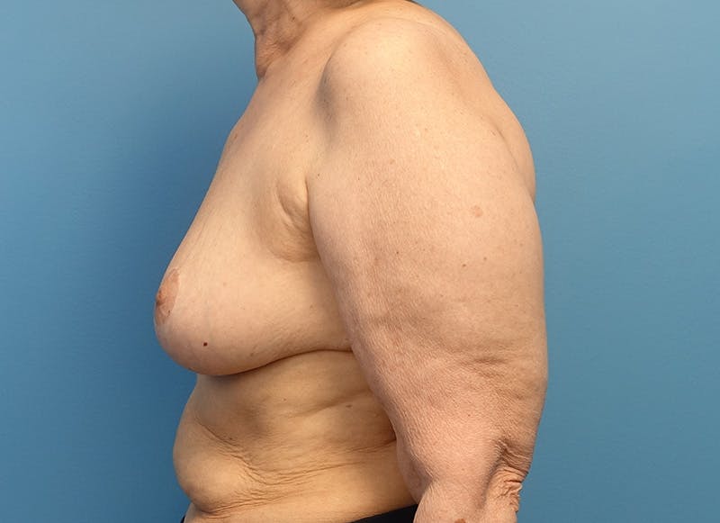 Breast Reduction Before & After Gallery - Patient 121727772 - Image 2