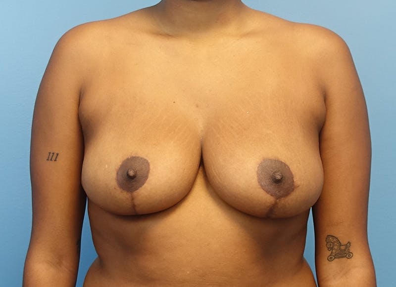 Breast Reduction Before & After Gallery - Patient 121727830 - Image 6