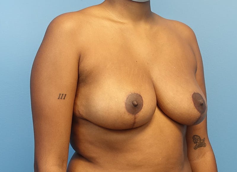 Breast Reduction Before & After Gallery - Patient 121727830 - Image 8