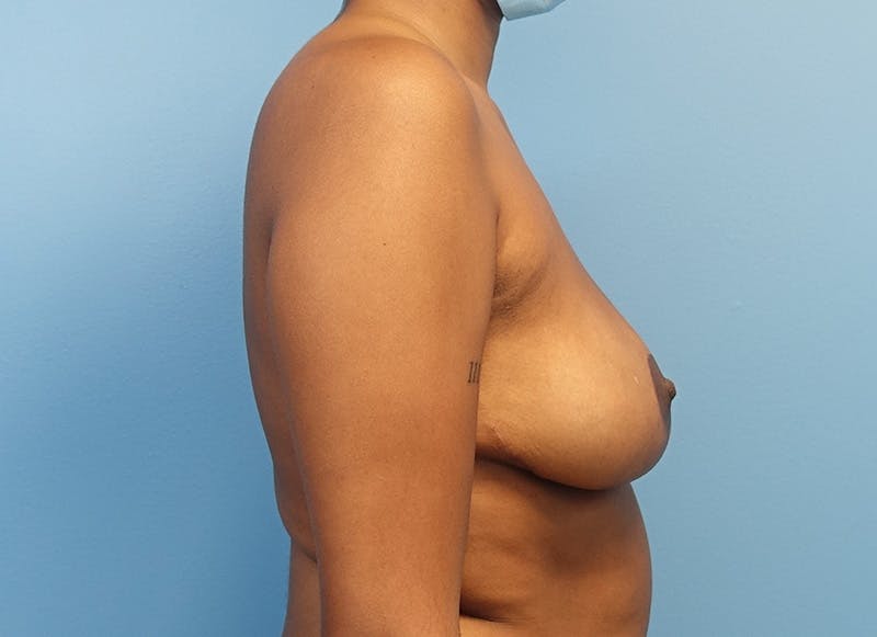 Breast Reduction Before & After Gallery - Patient 121727830 - Image 10