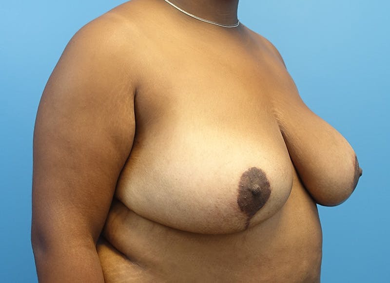 Breast Reduction Before & After Gallery - Patient 121727880 - Image 8