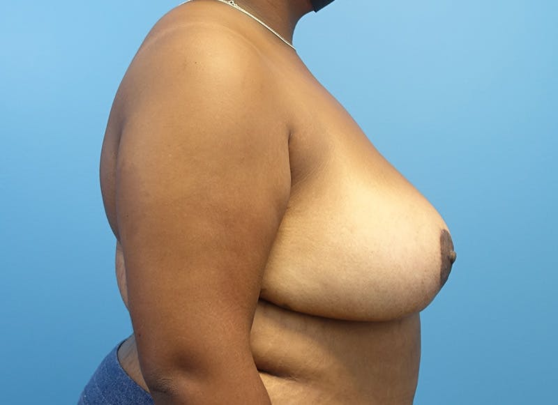 Breast Reduction Before & After Gallery - Patient 121727880 - Image 10