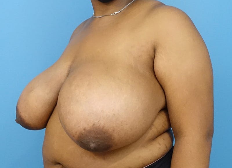 Breast Reduction Before & After Gallery - Patient 121727880 - Image 3