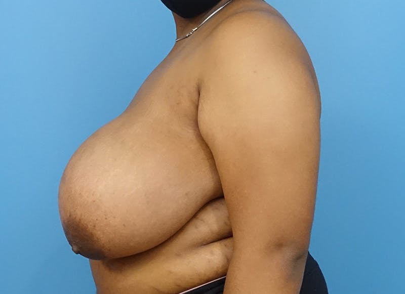Breast Reduction Before & After Gallery - Patient 121727880 - Image 1