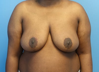 Breast Reduction Before & After Gallery - Patient 121727959 - Image 6