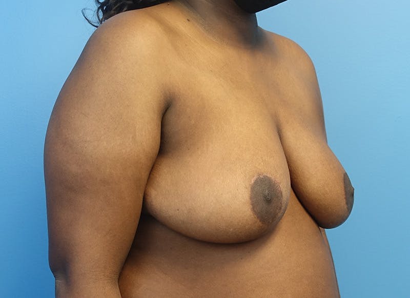 Breast Reduction Before & After Gallery - Patient 121727959 - Image 8