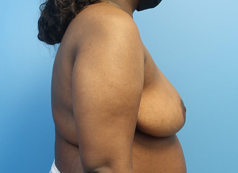 Breast Reduction Before & After Gallery - Patient 121727959 - Image 10