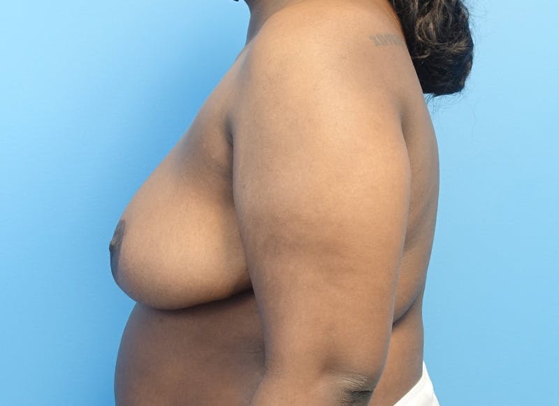 Breast Reduction Before & After Gallery - Patient 121727959 - Image 2