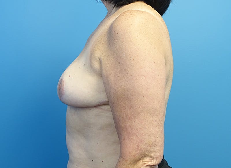 Breast Reduction Before & After Gallery - Patient 121728014 - Image 2
