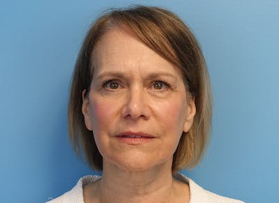 Facelift Before & After Gallery - Patient 121727146 - Image 6