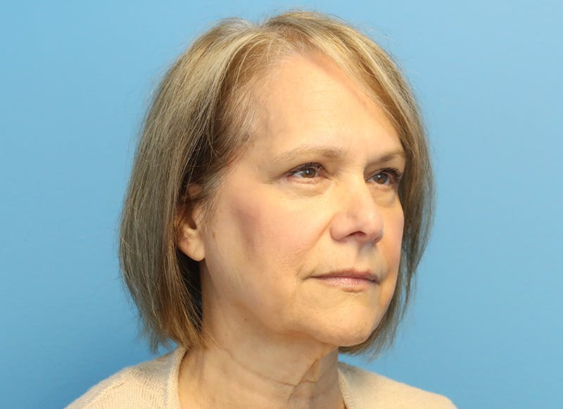 Facelift Before & After Gallery - Patient 121727146 - Image 7