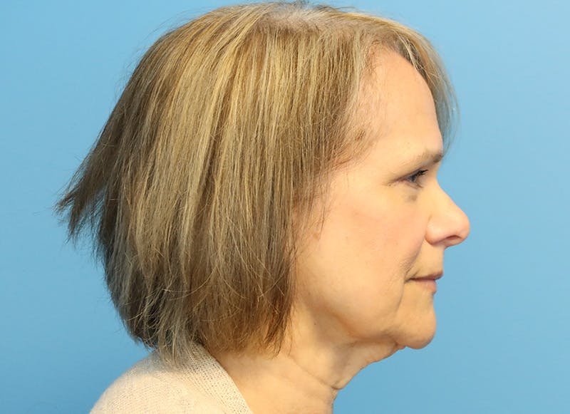 Facelift Before & After Gallery - Patient 121727146 - Image 9