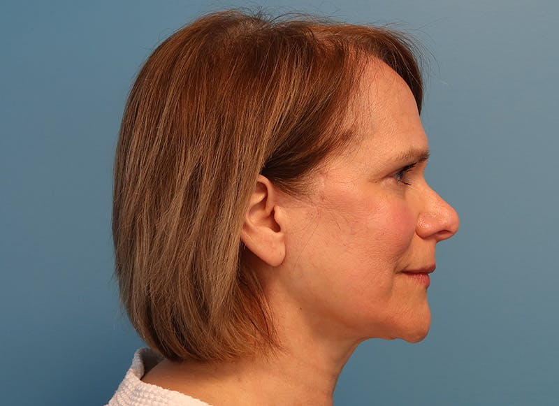 Facelift Before & After Gallery - Patient 121727146 - Image 10