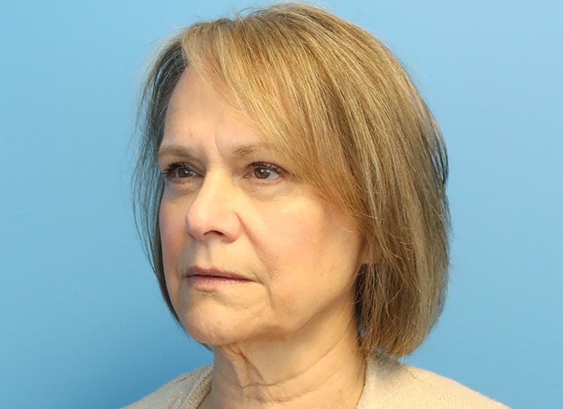 Facelift Before & After Gallery - Patient 121727146 - Image 3