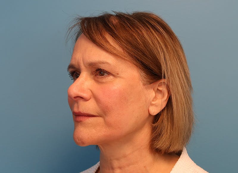 Facelift Before & After Gallery - Patient 121727146 - Image 4