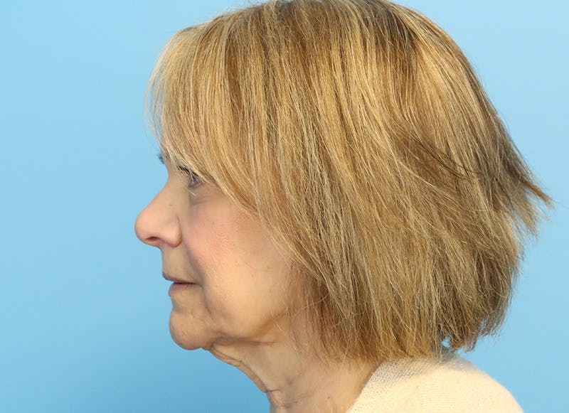 Facelift Before & After Gallery - Patient 121727146 - Image 1