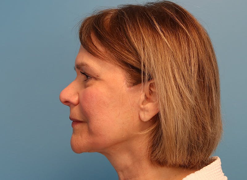 Facelift Before & After Gallery - Patient 121727146 - Image 2