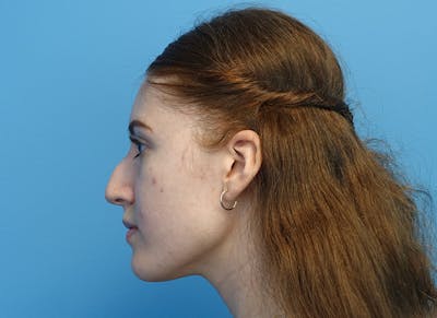 Rhinoplasty Before & After Gallery - Patient 179310101 - Image 1
