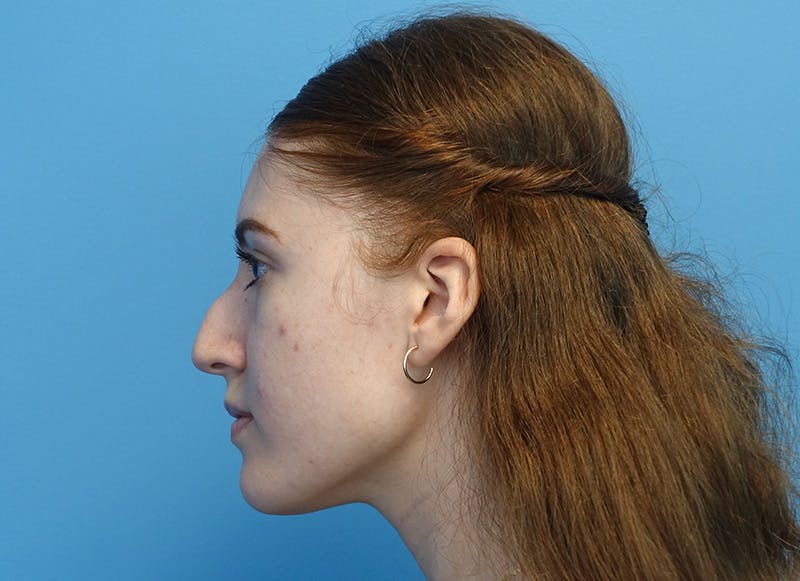 Rhinoplasty Before & After Gallery - Patient 121727056 - Image 1