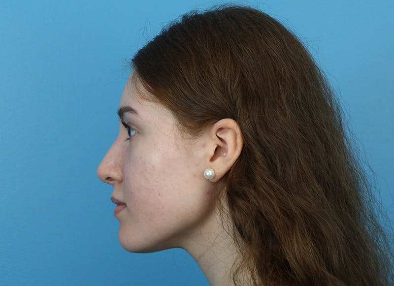 Rhinoplasty Before & After Gallery - Patient 179310101 - Image 2