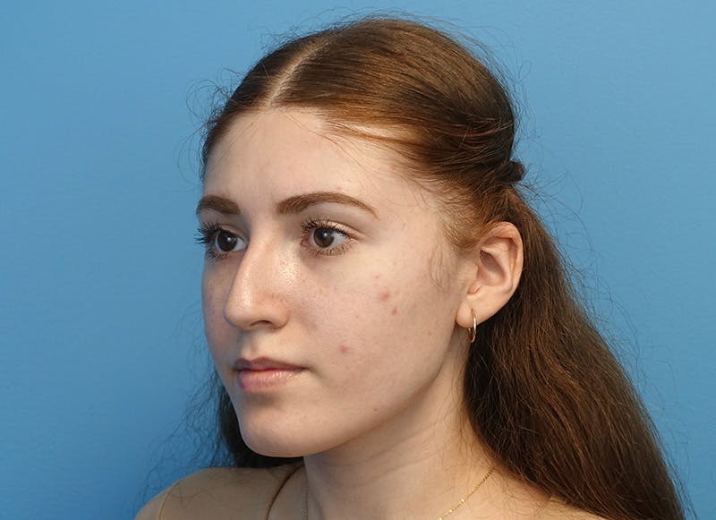 Rhinoplasty Before & After Gallery - Patient 121727056 - Image 3
