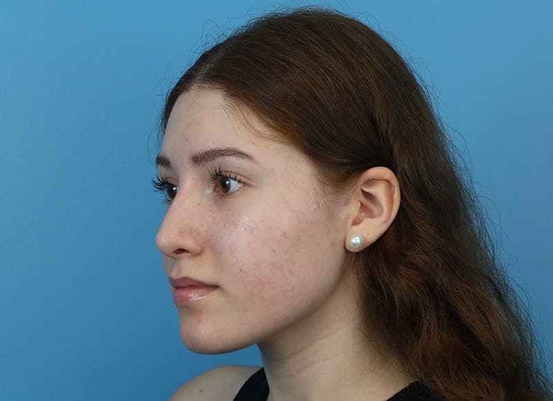Rhinoplasty Before & After Gallery - Patient 121727056 - Image 4