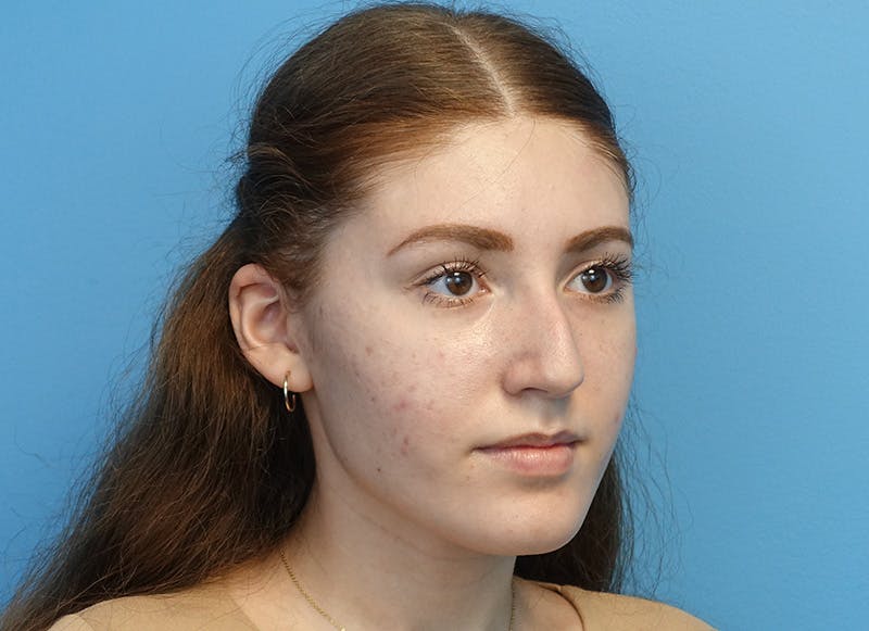 Rhinoplasty Before & After Gallery - Patient 121727056 - Image 7