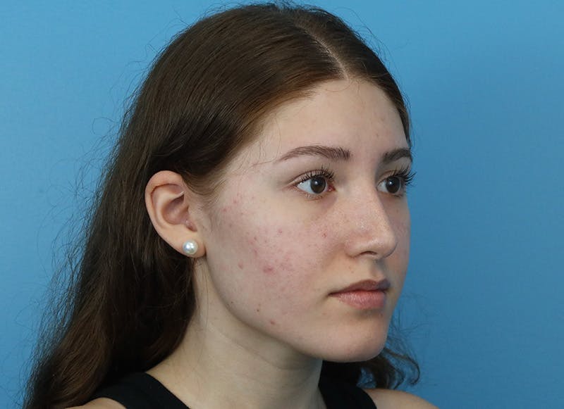 Rhinoplasty Before & After Gallery - Patient 179310101 - Image 8