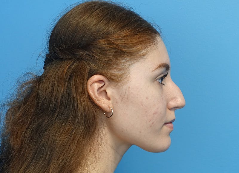 Rhinoplasty Before & After Gallery - Patient 179310101 - Image 9
