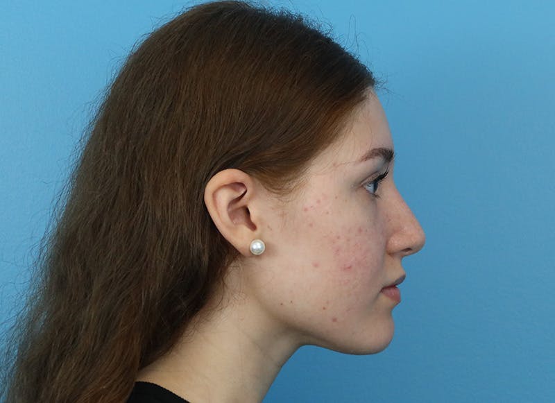 Rhinoplasty Before & After Gallery - Patient 121727056 - Image 10