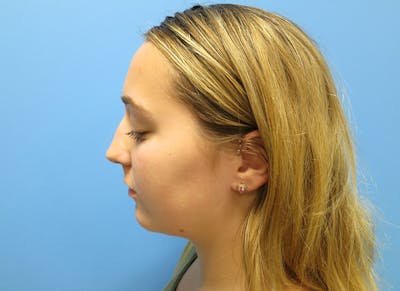 Rhinoplasty Before & After Gallery - Patient 112338611 - Image 1